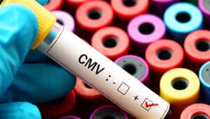 citomegalovírus